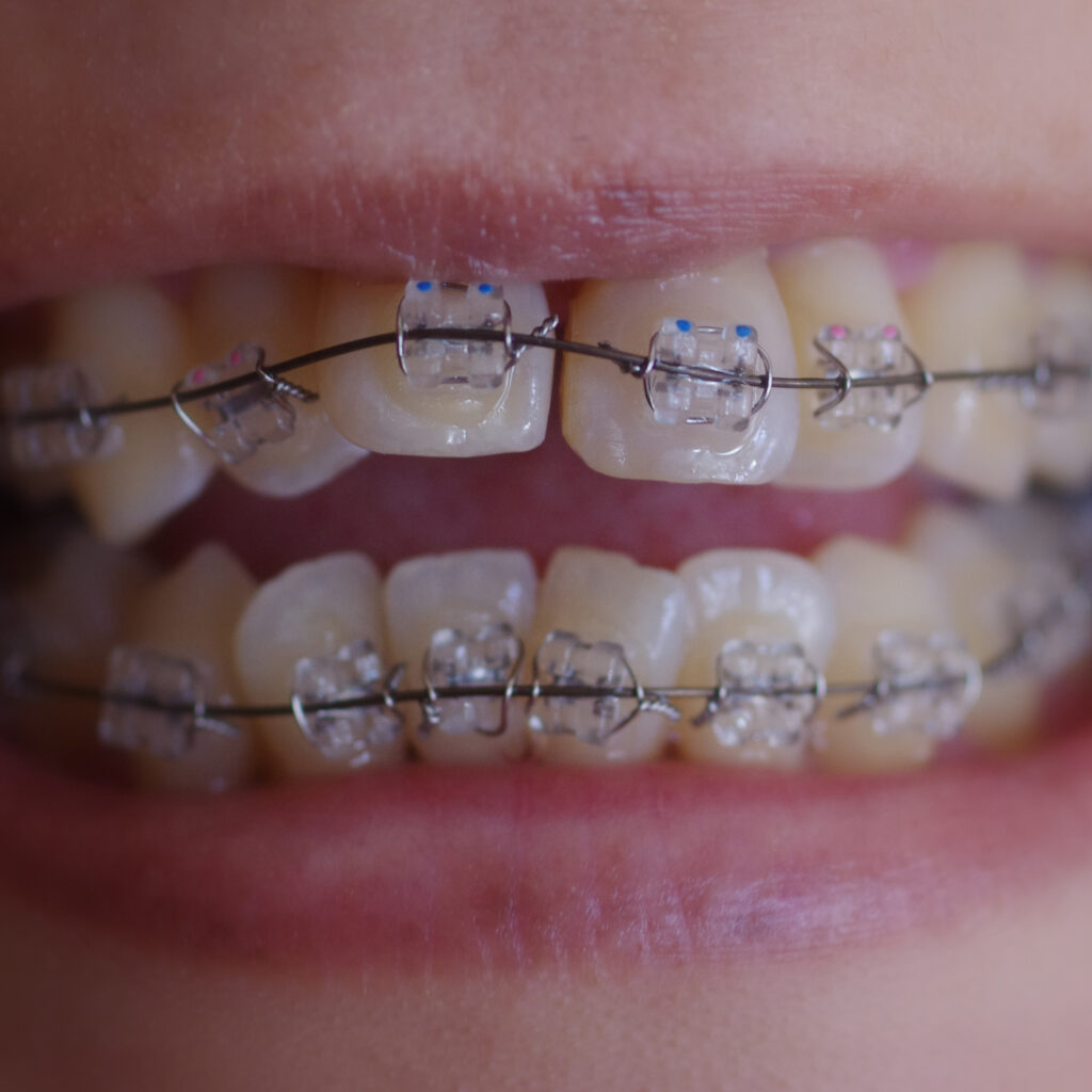 Ceramic braces are made with clear brackets. 