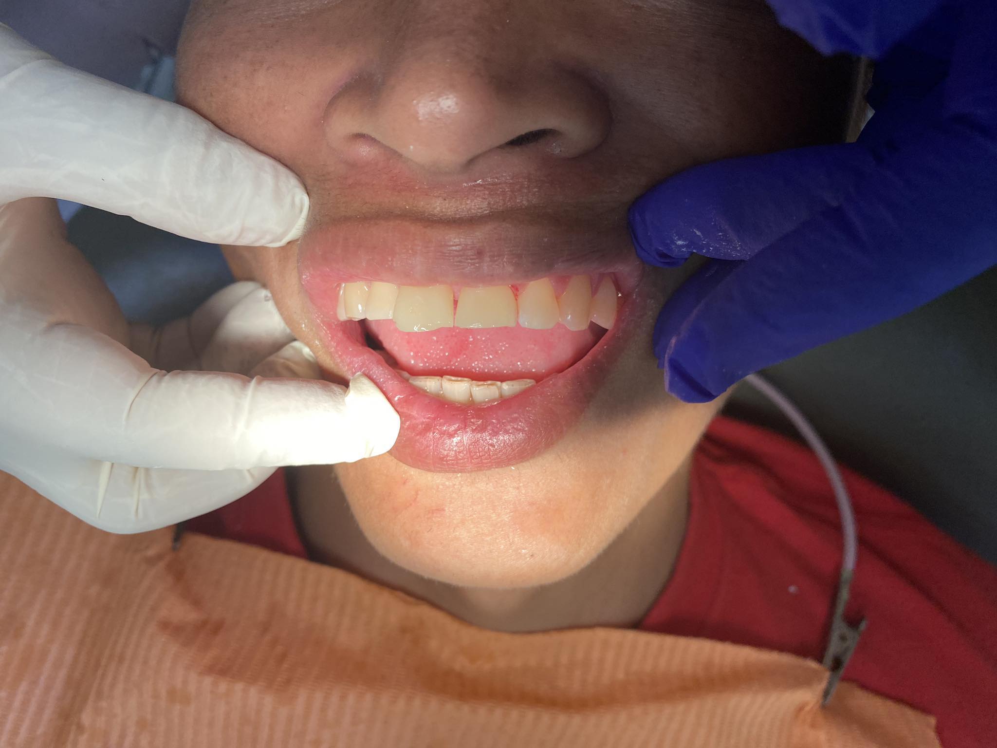 Dental Veneers WebDMD