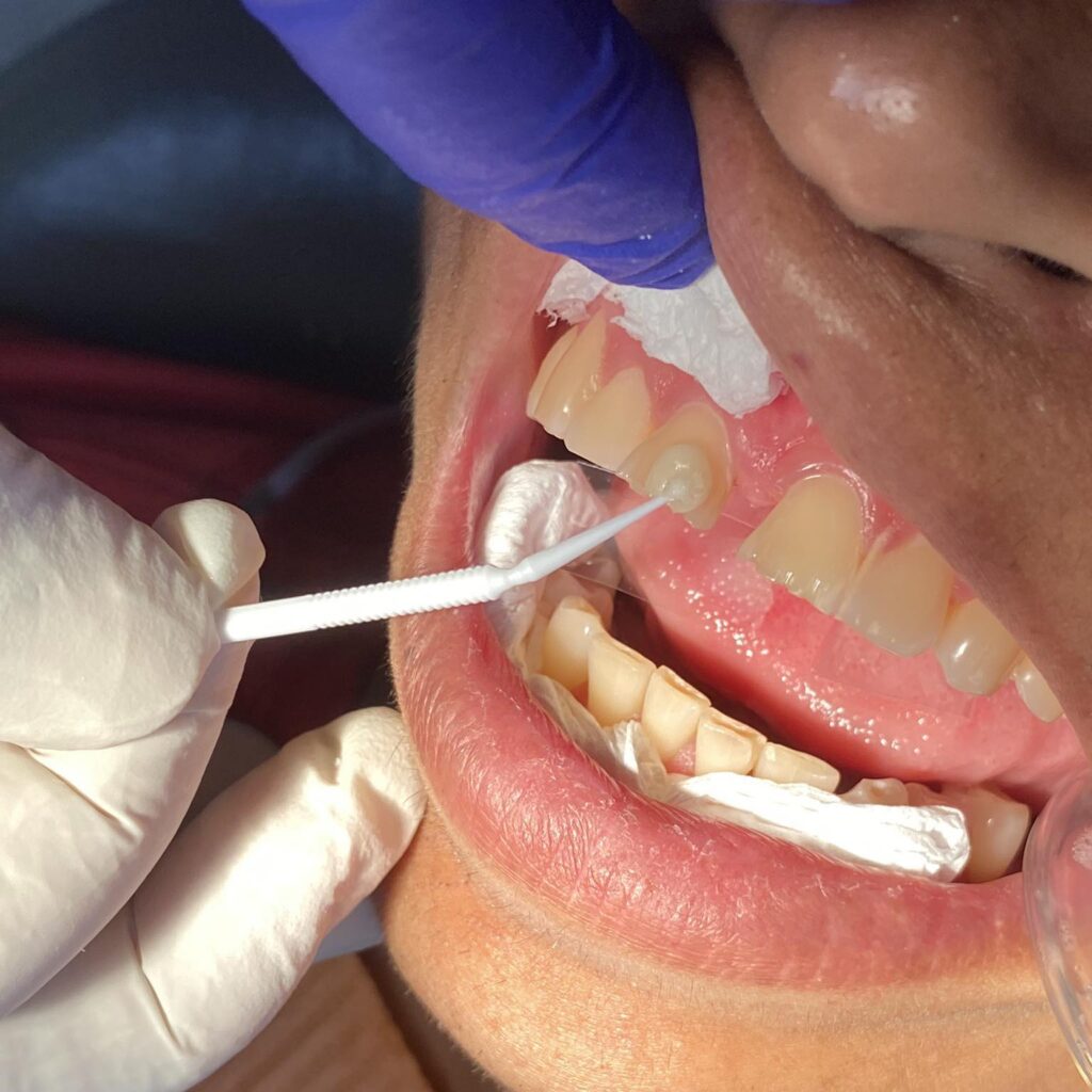 Composite veneers can be repaired by adding composite if suddenly a portion of it becomes chipped. 