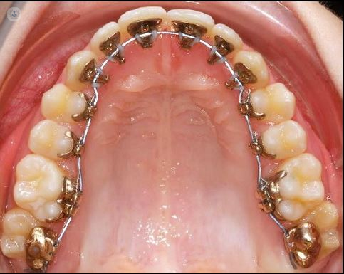 Lingual braces are braces where the brackets are placed at the back or lingual portion of your teeth. 
