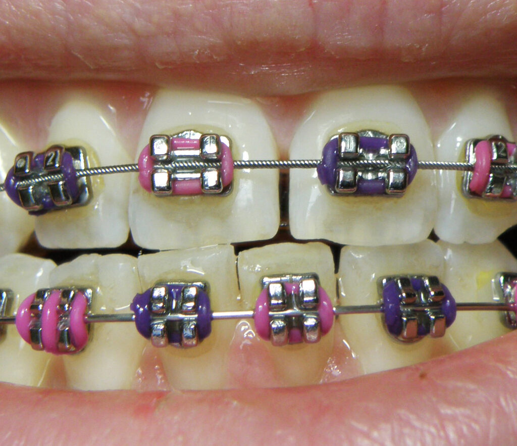 Metal braces are fixed metal apparatus that is attached to teeth through brackets, wires, and bands.