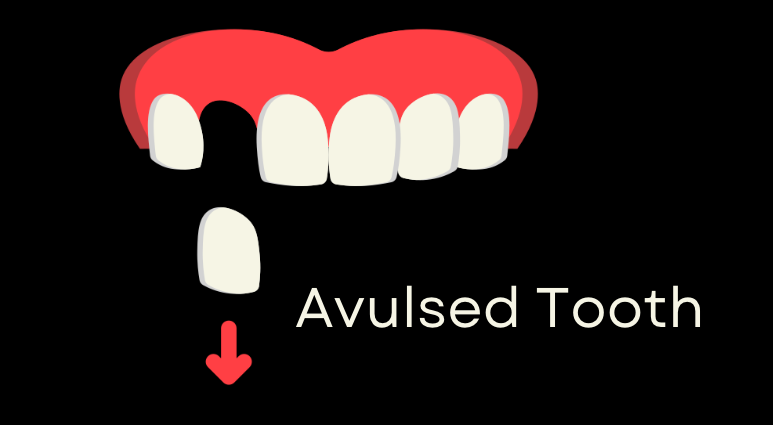 Avulsed Tooth