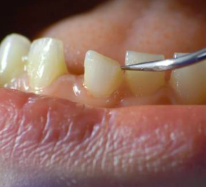 Loose Tooth: What You Should Do About It