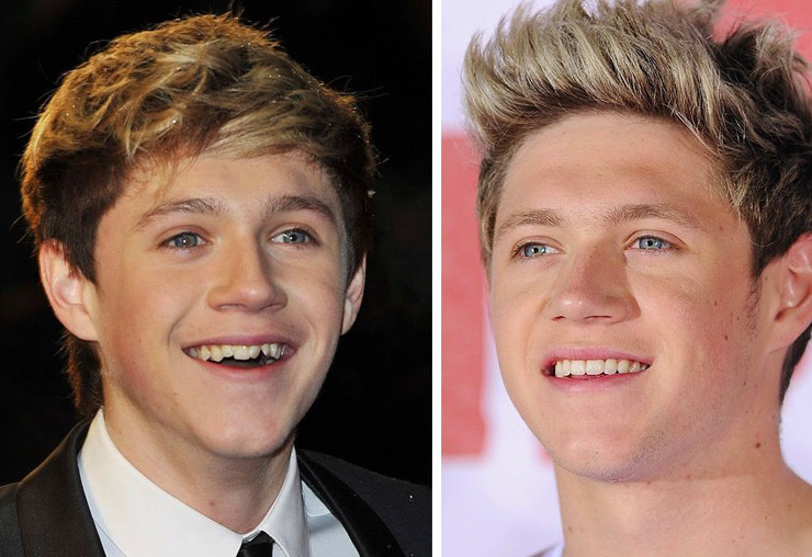 Niall Horan's buck teeth