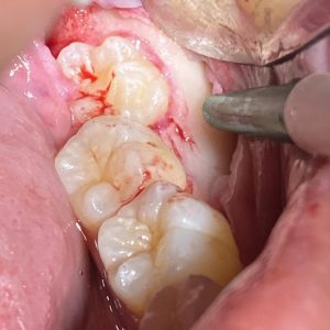 DENTISTRY 101: Flap Surgery in Dentistry