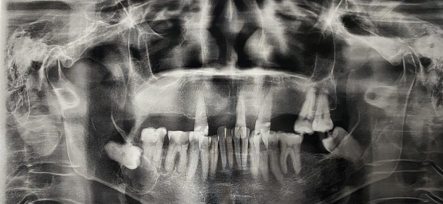 Panoramic Xray showing how close the maxillary teeth's roots to the maxillary sinuses' borders.